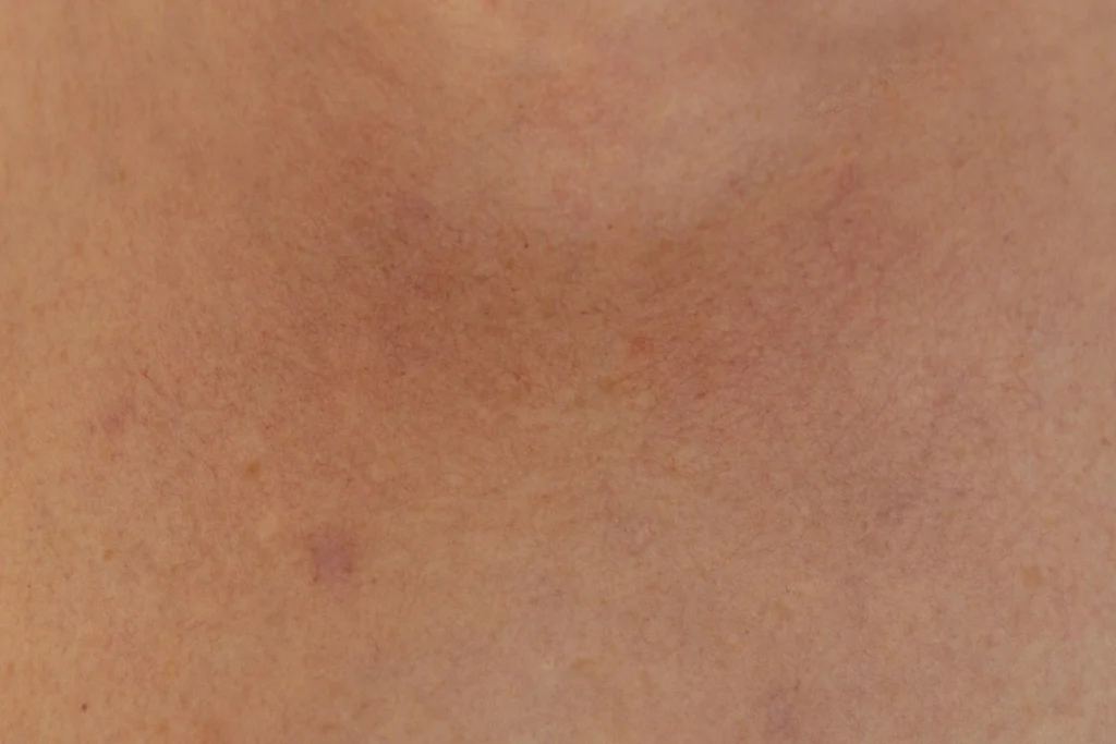 How skin quality affects surgical results