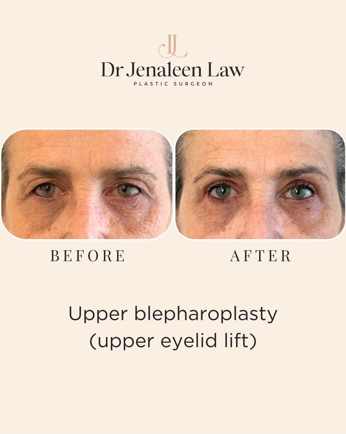 Our lovely patient had significant excess upper eyelid skin that was affecting her vision. The skin was resting over her